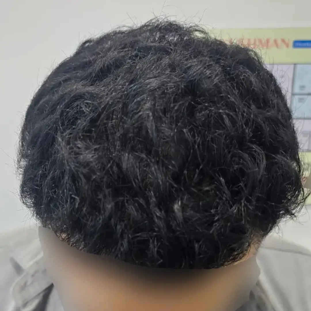 HAIR-TRANSPLANT-AFTER (1)