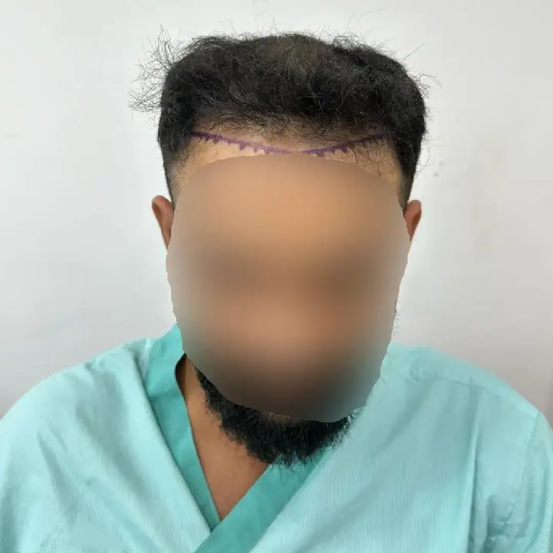 HAIR-TRANSPLANT-AFTER