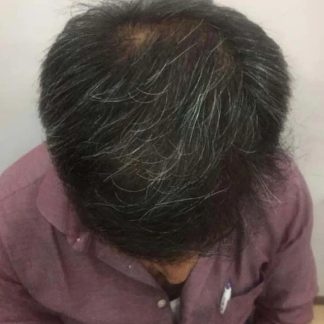 HAIR-TRANSPLANT-AFTER