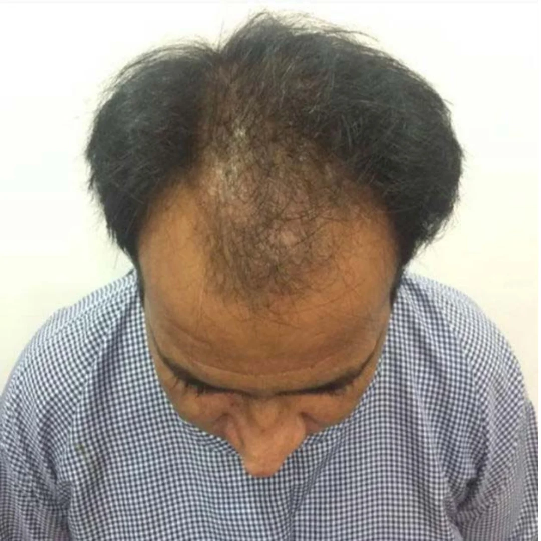 HAIR-TRANSPLANT-BEFORE