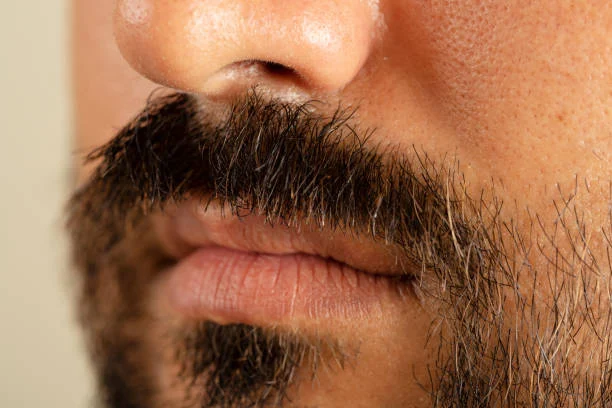 Moustache Hair Transplant