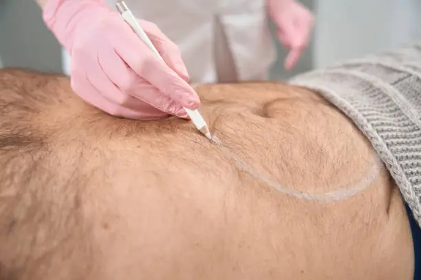 body hair transplant in dwarka